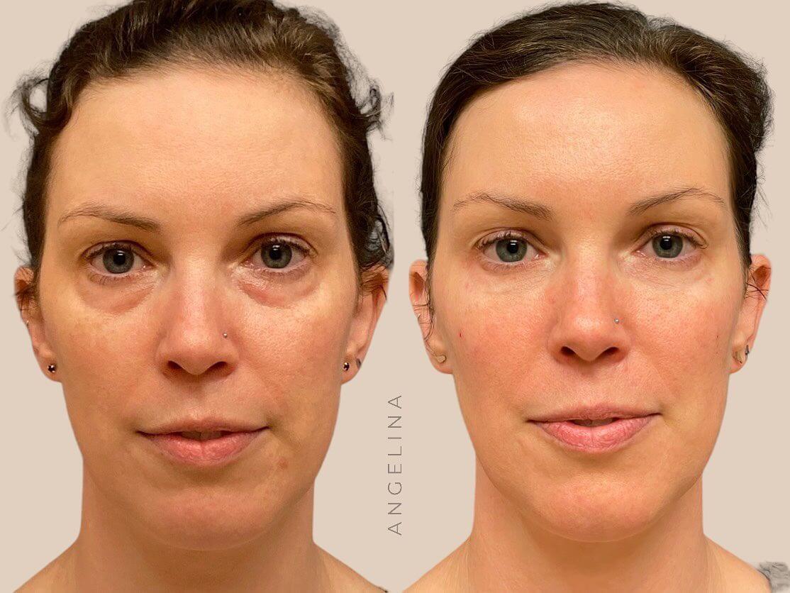 Before and after photos of a woman showing the results of dermal fillers, with improvements in skin texture and reduced under-eye hollows.