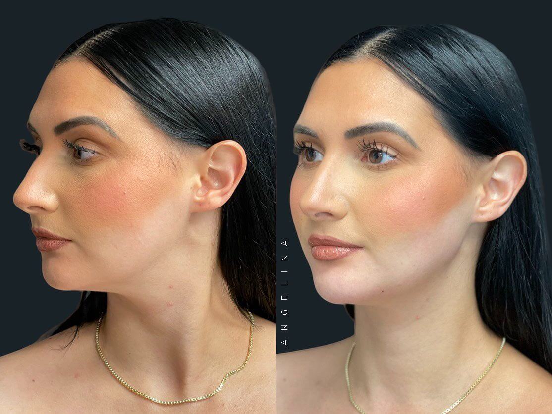 Before and after jawline filler at Austin Aesthetic Atelier showing enhanced jawline definition and a sharper, more contoured profile.