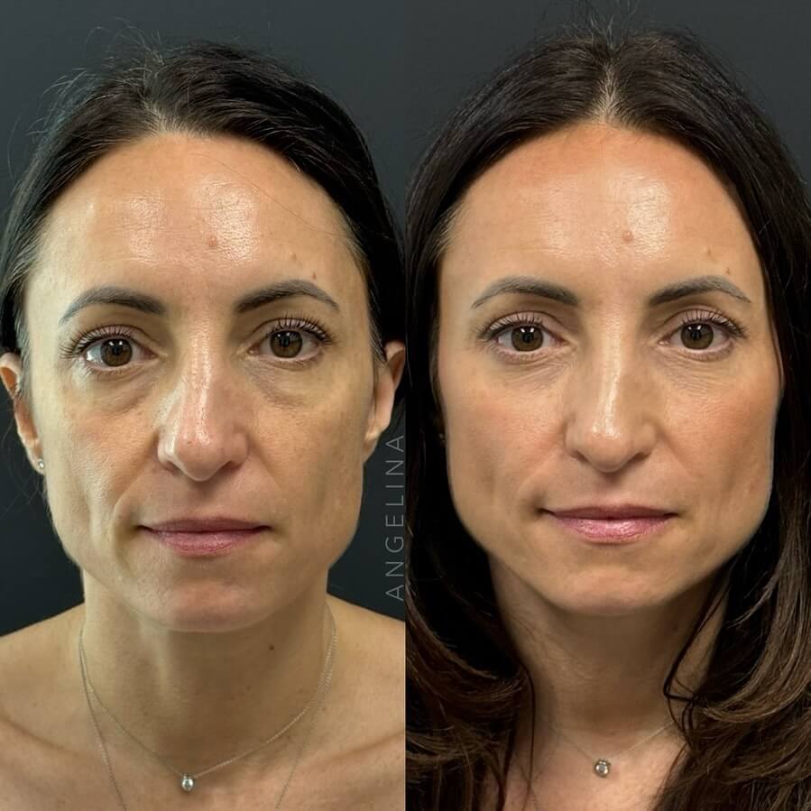 Before and after full facial balancing at Austin Aesthetic Atelier showing enhanced facial symmetry and a refreshed, youthful appearance.